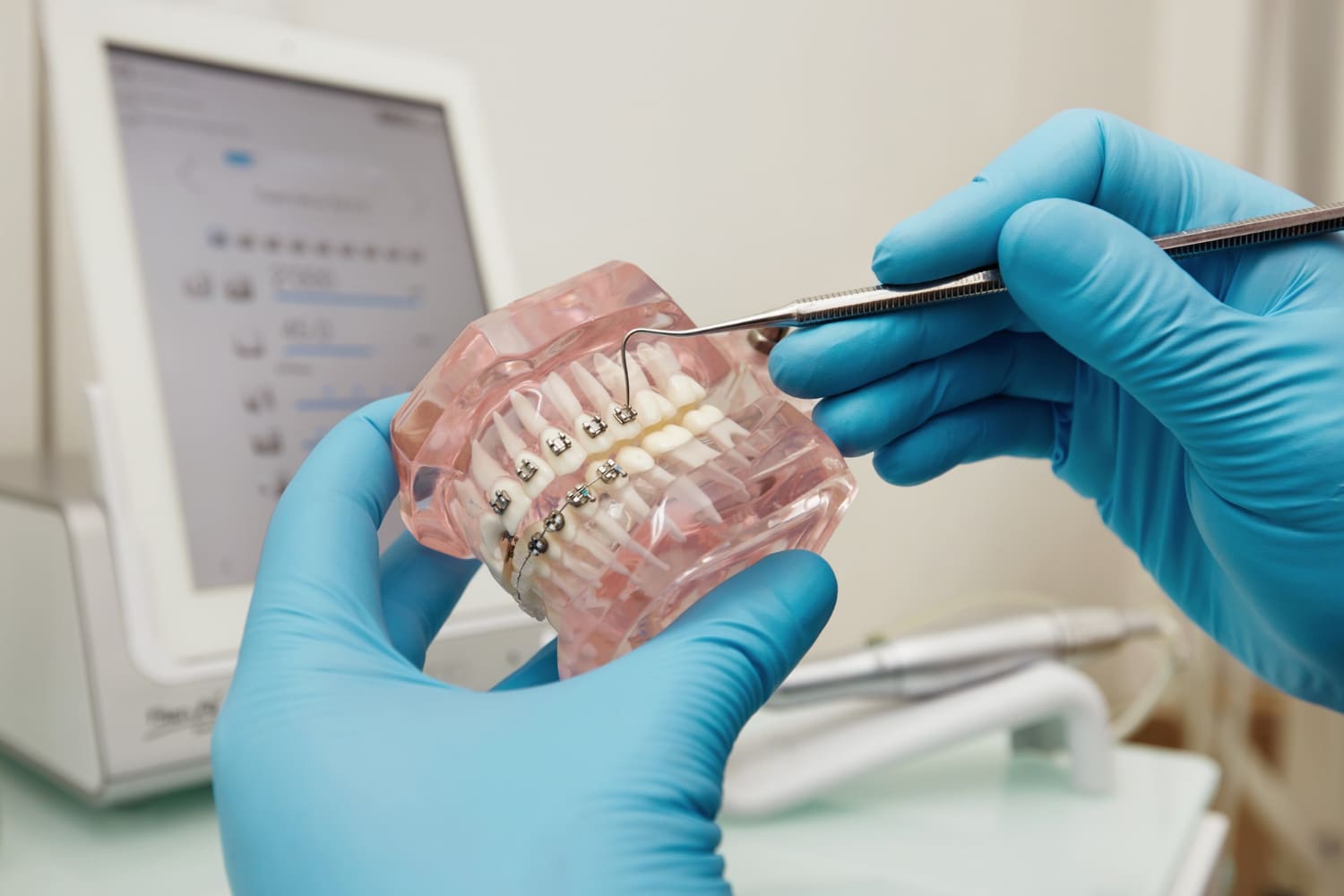 Коррекция формы зубов без сверления